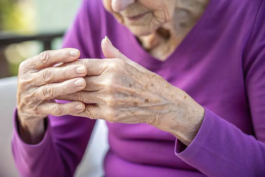 arthrose des mains